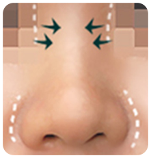 HIKO隆鼻術-寬鼻